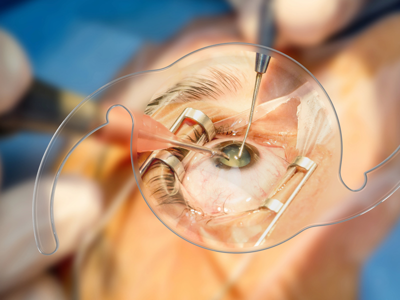 Cirugía de Cataratas