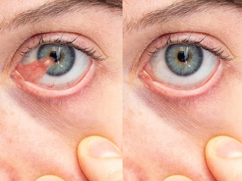 Cirugía de Pterigión